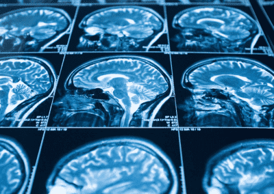 The Default Mode Network – A Key Brain Network in Dissociation and for Restoring the Sense of Self in Those with PTSD