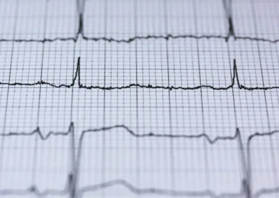 Heart Rate in Trauma: Patterns Found in Somatic Experiencing and Trauma Resolution